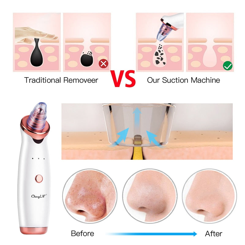 Ultrasonic Skin Scrubber - Facial Peeling Pore Cleaner Exfoliator